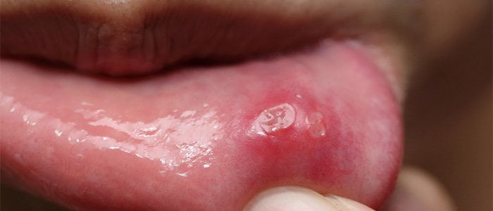 What does your mouth say about you mouth ulcer