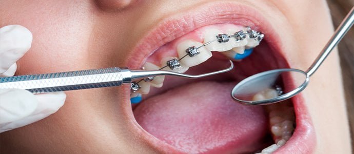 Make-oral-health-part-of-your-New-Years-Resolutions-braces