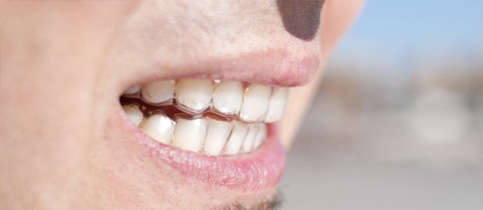Receding gums Causes and solutions