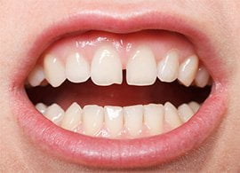 Receding gums Causes and solutions
