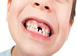 child with missing tooth