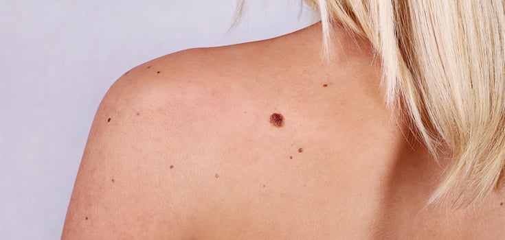 woman with sun spots on her back