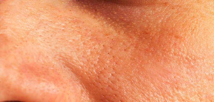 facial skin with open pores