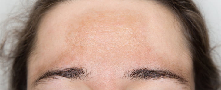 Skin pigmentation on the forehead