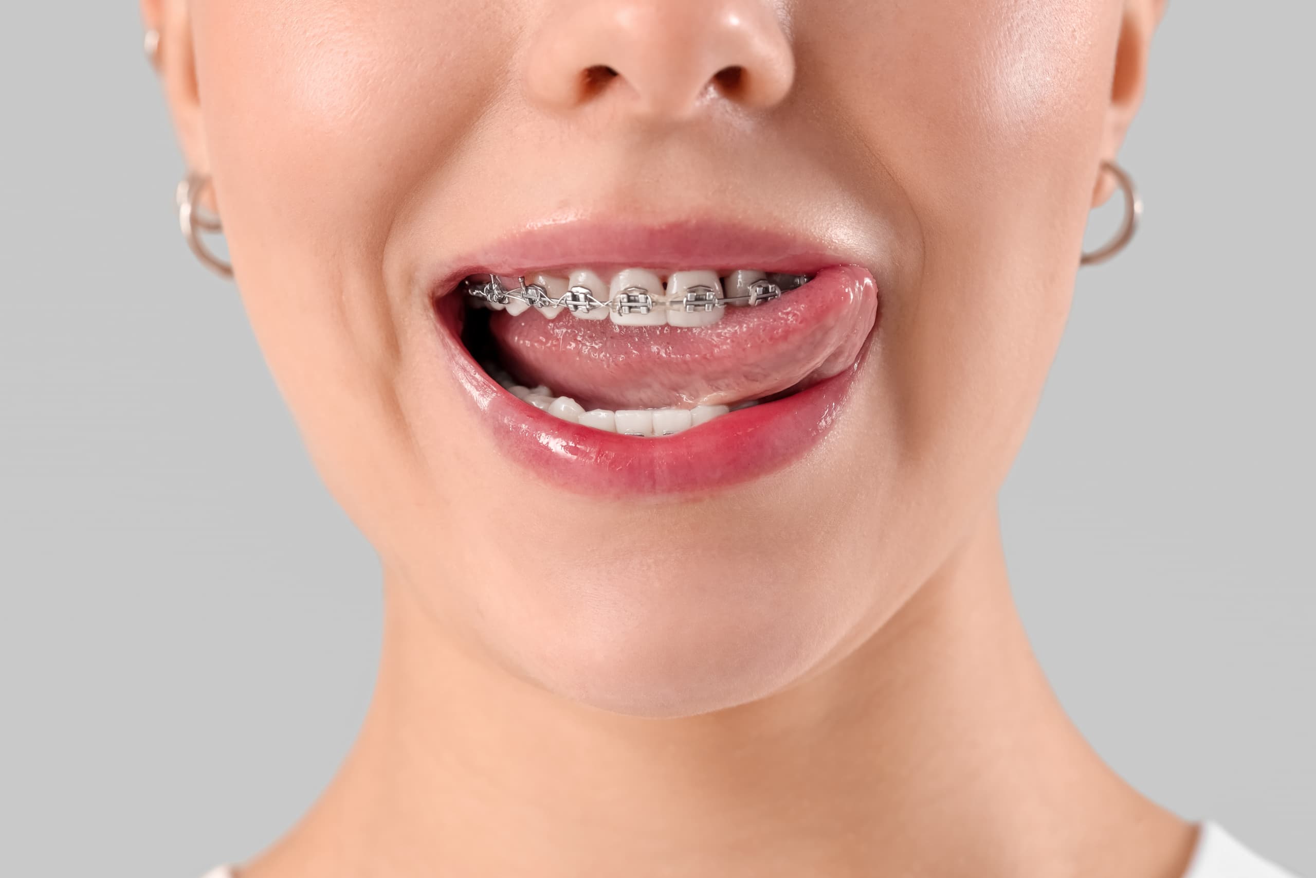 close up shot of adult woman smiling with braces and her tongue sticking out