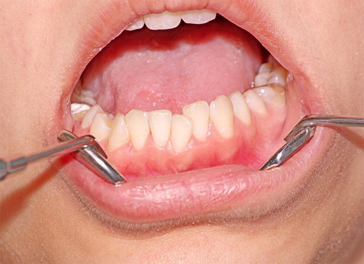 What causes crooked teeth?