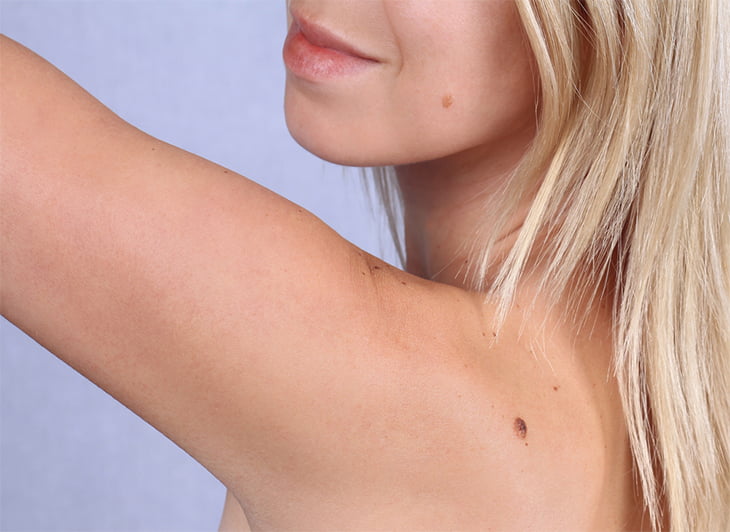 The mole truth: Should you worry about your moles?