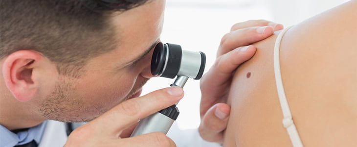 doctor checking mole on skin