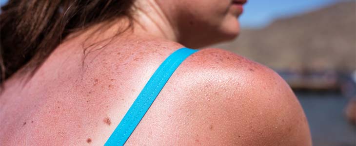 sunburnt skin