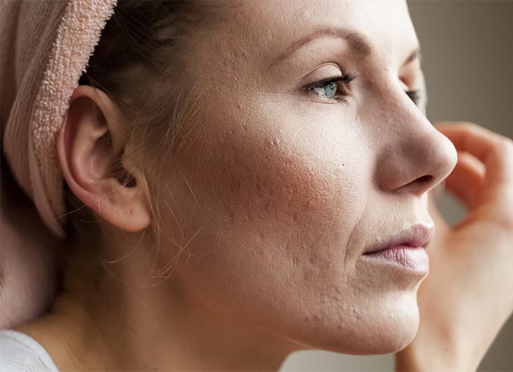 what is rosacea and how can it be treated feature image