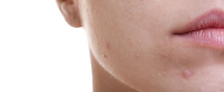 girl suffering from acne