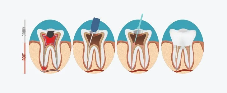 root canal diagram
