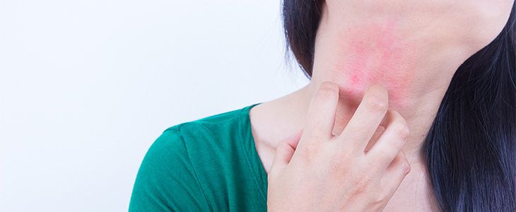 irritating eczema by scratching.