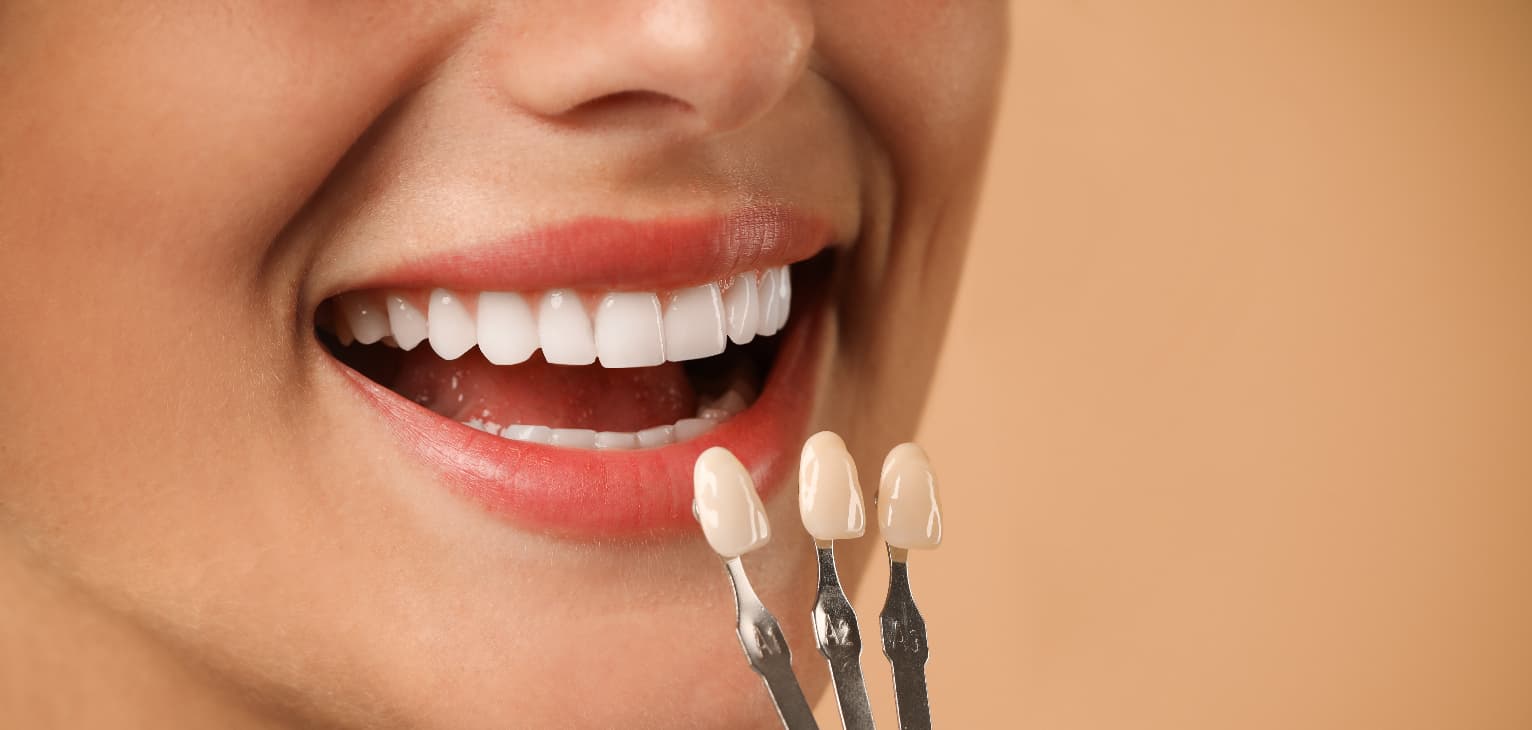 Close-up of a smiling patient with bright, even teeth alongside porcelain veneer shade samples, illustrating cosmetic dental veneer treatment and smile enhancement options.