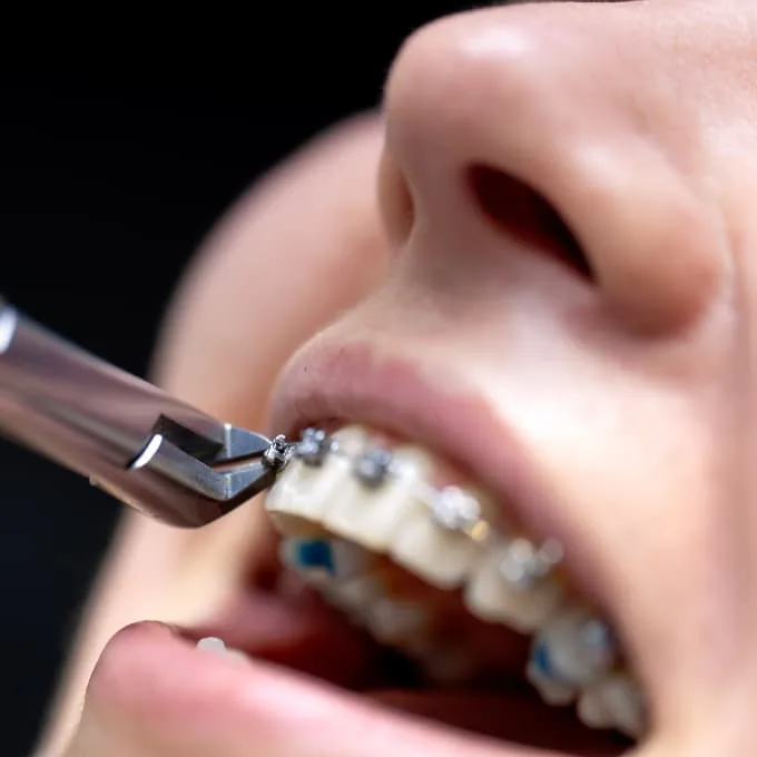 close up of patient receiving orthodontic treatment