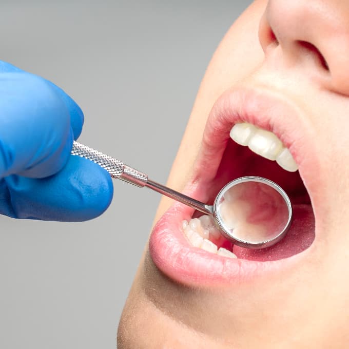 Dentist carrying out a routine oral examination using a dental mirror to inspect a patient's teeth and overall oral health during a check-up appointment.